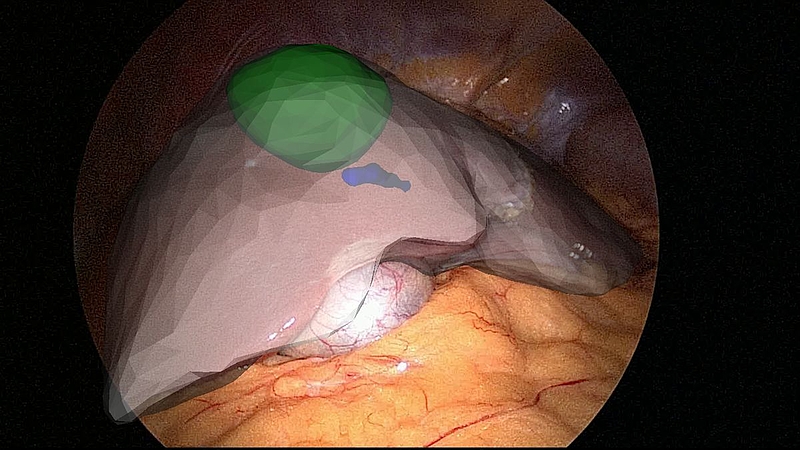 Computerunterstützte Chirurgie: Mit Hilfe von Augmented Reality wird die Anatomie des zu operierenden Organs während der Operation eingeblendet.